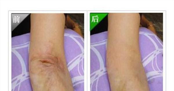 燒傷疤痕修復注意事項是什么?