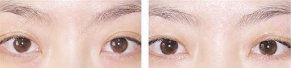 激光<a href=http://m.f3bb6.cn/listinfo-782-0.html target=_blank class=infotextkey>去眼角細(xì)紋</a>手術(shù)安全嗎？