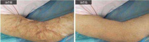 做燙傷疤痕修復價格要多少