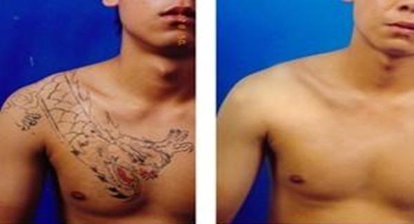 做<a href=http://m.f3bb6.cn/listinfo-793-0.html target=_blank class=infotextkey>洗紋身</a>手術時間是多久？