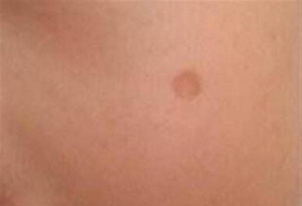 點痣后留疤了該怎么辦