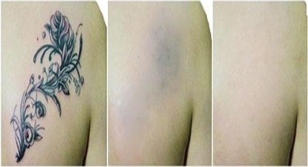 做激光<a href=http://m.f3bb6.cn/listinfo-793-0.html target=_blank class=infotextkey>洗紋身</a>副作用