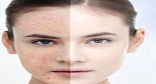 做微晶磨皮去痘印副作用