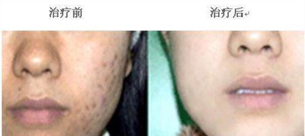 <a href=http://m.f3bb6.cn/listinfo-779-0.html target=_blank class=infotextkey>治療痤瘡</a>手術安全嗎？