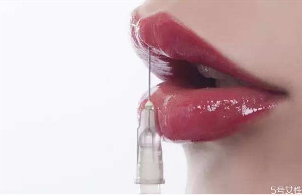 嘴唇打透明質酸好不好 透明質酸豐唇幾天較好看