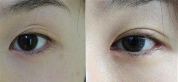 做眼瞼疤痕修復(fù)價(jià)格要多少