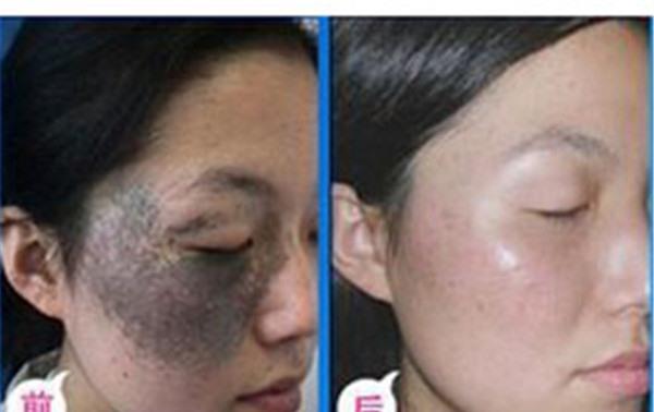 做激光<a href=http://m.f3bb6.cn/listinfo-799-0.html target=_blank class=infotextkey>去太田痣</a>價格