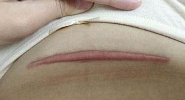 做剖腹產疤痕修復手術注意事項是什么？