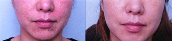 透明質酸<a href=http://m.f3bb6.cn/listinfo-797-0.html target=_blank class=infotextkey>去痘疤</a>手術安全嗎？