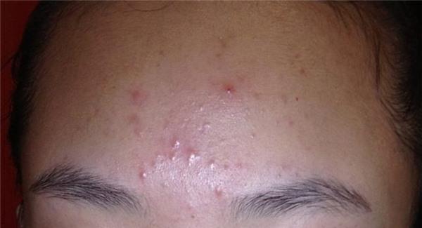 <a href=http://m.f3bb6.cn/listinfo-797-0.html target=_blank class=infotextkey>去痘疤</a>痛么