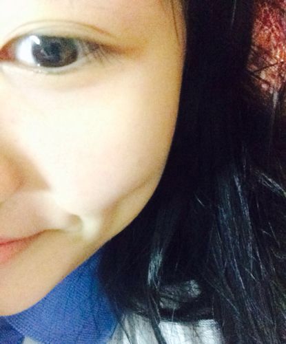 酒窩成形術后應該怎么護理呢