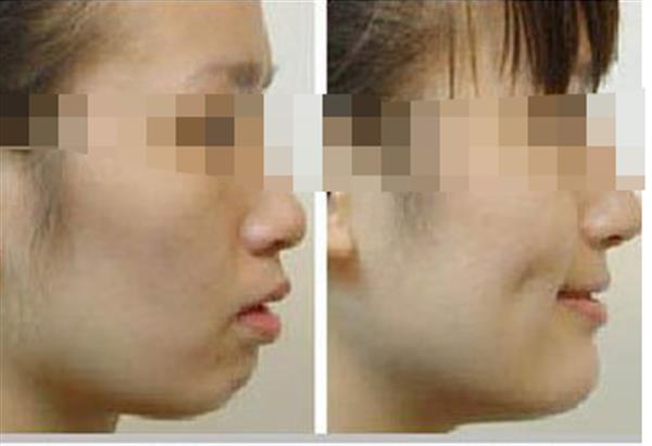 <a href=http://m.f3bb6.cn/listinfo-637-0.html target=_blank class=infotextkey>酒窩整形</a>手術是否安全