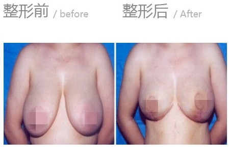 <a href=http://m.f3bb6.cn/listinfo-617-0.html target=_blank class=infotextkey>巨乳縮小</a>術(shù)的術(shù)前準(zhǔn)備和術(shù)后護(hù)理