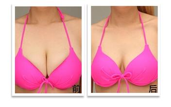 <a href=http://m.f3bb6.cn/listinfo-617-0.html target=_blank class=infotextkey>巨乳縮小</a>術的手術過程及護理