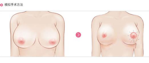 <a href=http://m.f3bb6.cn/listinfo-617-0.html target=_blank class=infotextkey>巨乳縮小</a>術的價格及手術準備工作