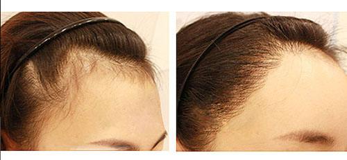 發(fā)際線過低怎么處理