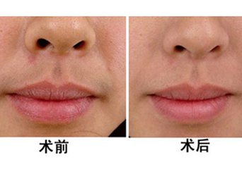 激光<a href=http://m.f3bb6.cn/listinfo-665-0.html target=_blank class=infotextkey>脫唇毛</a>會復發嗎