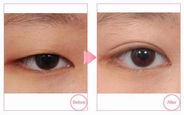 重瞼術的優缺點詳解