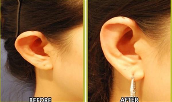 兜風耳矯正術是怎樣進行的