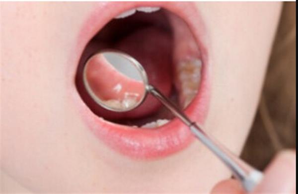 鵝口瘡用什么藥好得快