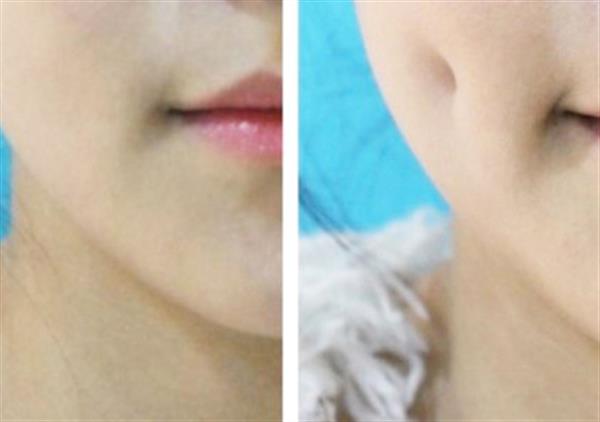 酒窩成形術(shù)的效果及風(fēng)險如何