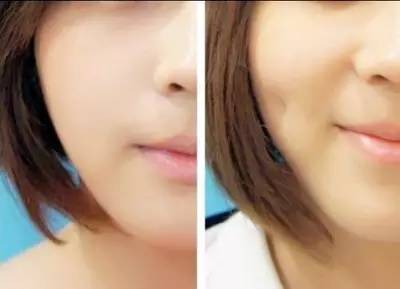 酒窩成形術過程中會疼痛嗎