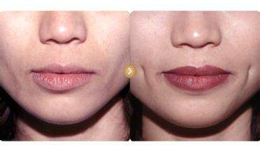 酒窩成形術(shù)通常有哪幾類做法