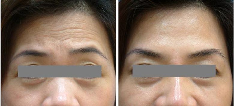 激光<a href=http://m.f3bb6.cn/listinfo-765-0.html target=_blank class=infotextkey>去抬頭紋</a>危害