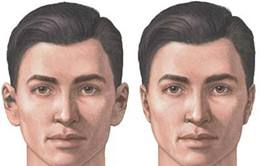 招風(fēng)耳手術(shù)反彈很難看