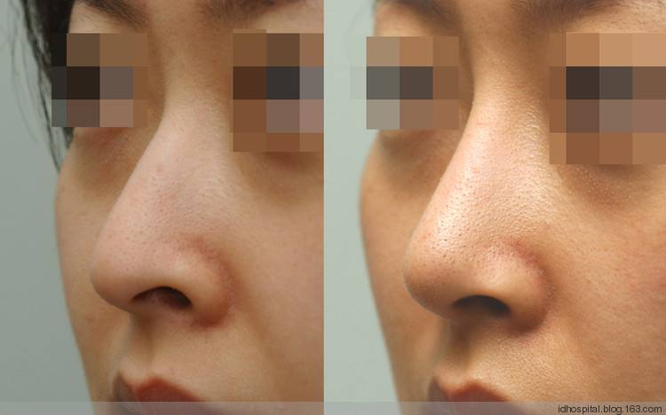 韓式<a href=http://m.f3bb6.cn/listinfo-737-0.html target=_blank class=infotextkey>隆鼻</a>整形需要多少錢啊