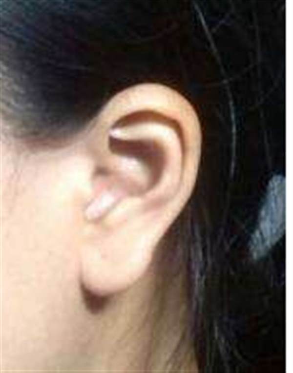 杯狀耳需要做整形手術(shù)嗎
