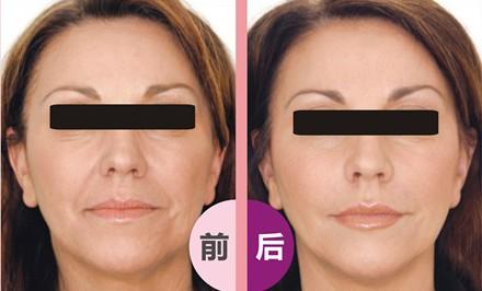 做激光祛皺術后應該如何護理呢