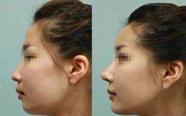 沈陽(yáng)哪里可以做韓式<a href=http://m.f3bb6.cn/listinfo-737-0.html target=_blank class=infotextkey>隆鼻</a>