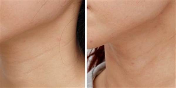 深圳怎么樣去除頸紋