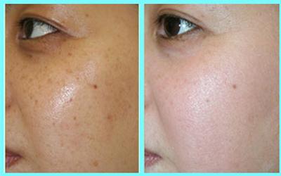 復合彩光<a href=http://m.f3bb6.cn/listinfo-776-0.html target=_blank class=infotextkey>去曬斑</a>效果好嗎