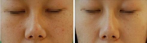 復(fù)合彩光<a href=http://m.f3bb6.cn/listinfo-776-0.html target=_blank class=infotextkey>去曬斑</a>要多少錢