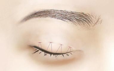 單眼皮適合什么<a href=http://m.f3bb6.cn/listinfo-724-0.html target=_blank class=infotextkey>雙眼皮</a>貼