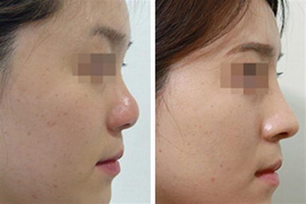 韓式<a href=http://m.f3bb6.cn/listinfo-737-0.html target=_blank class=infotextkey>隆鼻</a>前后對比圖