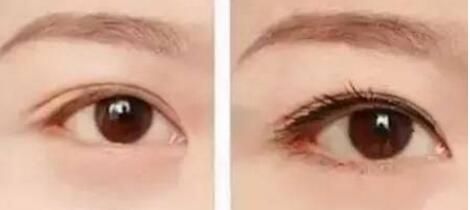 翹睫美瞳真人整形前后對比