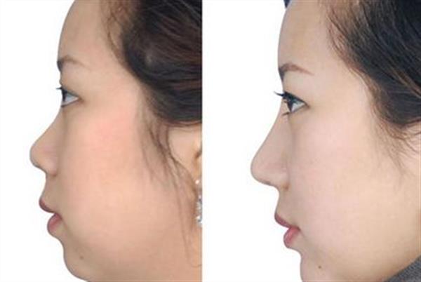 韓式<a href=http://m.f3bb6.cn/listinfo-737-0.html target=_blank class=infotextkey>隆鼻</a>前后對比照片