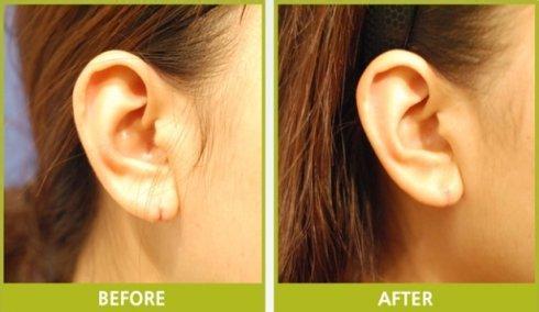耳朵整形的年齡