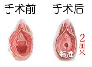 處釹膜破裂前后對比