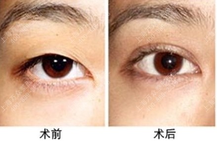 做<a href=http://m.f3bb6.cn/listinfo-724-0.html target=_blank class=infotextkey>雙眼皮</a>手術有后遺癥嗎