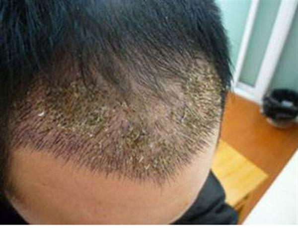 南京頭發種植的價格