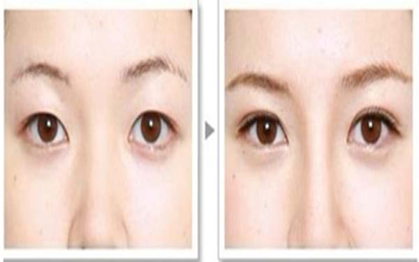 埋線(xiàn)<a href=http://m.f3bb6.cn/listinfo-724-0.html target=_blank class=infotextkey>雙眼皮</a>要拆線(xiàn)嗎