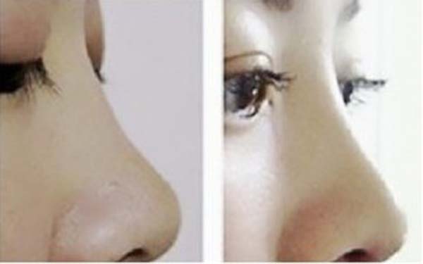 硅膠<a href=http://m.f3bb6.cn/listinfo-737-0.html target=_blank class=infotextkey>隆鼻</a>取出后能恢復原樣嗎