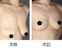 大乳房下垂整形多少錢