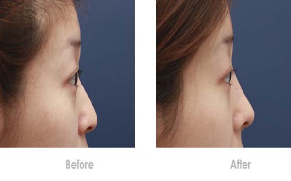 硅膠<a href=http://m.f3bb6.cn/listinfo-737-0.html target=_blank class=infotextkey>隆鼻</a>假體取出有沒有危險