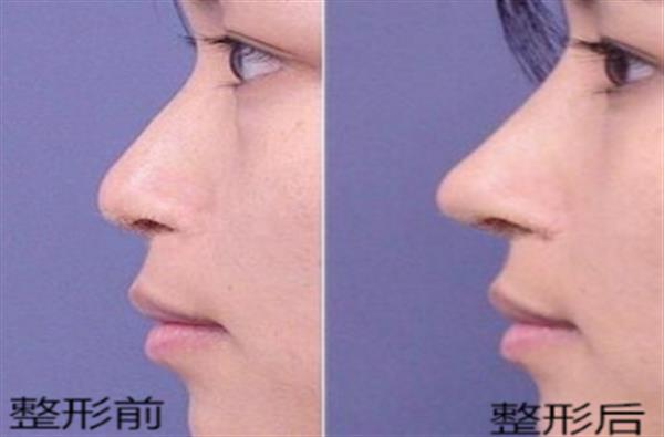 透明質酸<a href=http://m.f3bb6.cn/listinfo-737-0.html target=_blank class=infotextkey>隆鼻</a>前后恢復對比圖