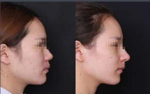 硅膠<a href=http://m.f3bb6.cn/listinfo-737-0.html target=_blank class=infotextkey>隆鼻</a>是長期的嗎